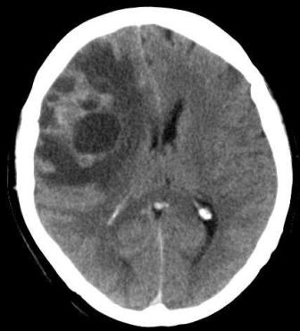 Комп'ютерна томографія КТ головного мозку в Черкасах