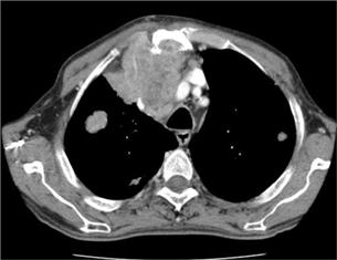 Комп'ютерна томографія КТ грудної порожнини