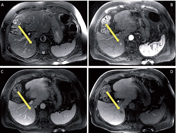 томографія печінки